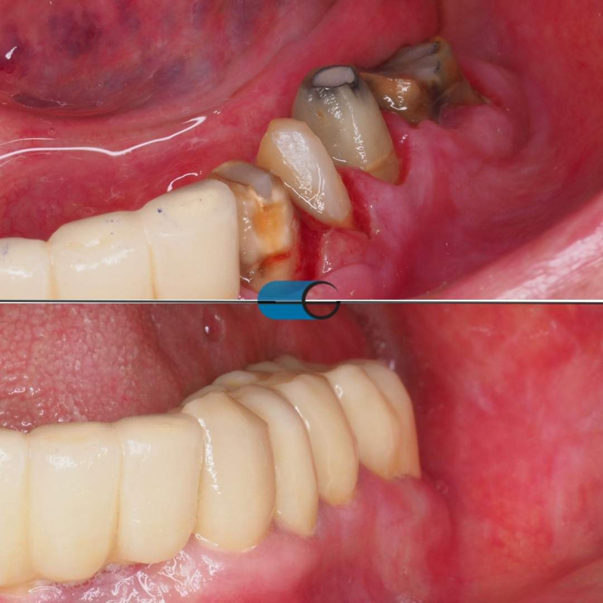 Ponte fixa posterior