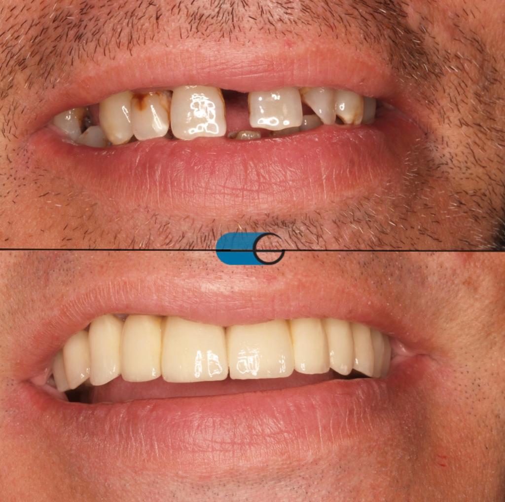 Implantes Dentários