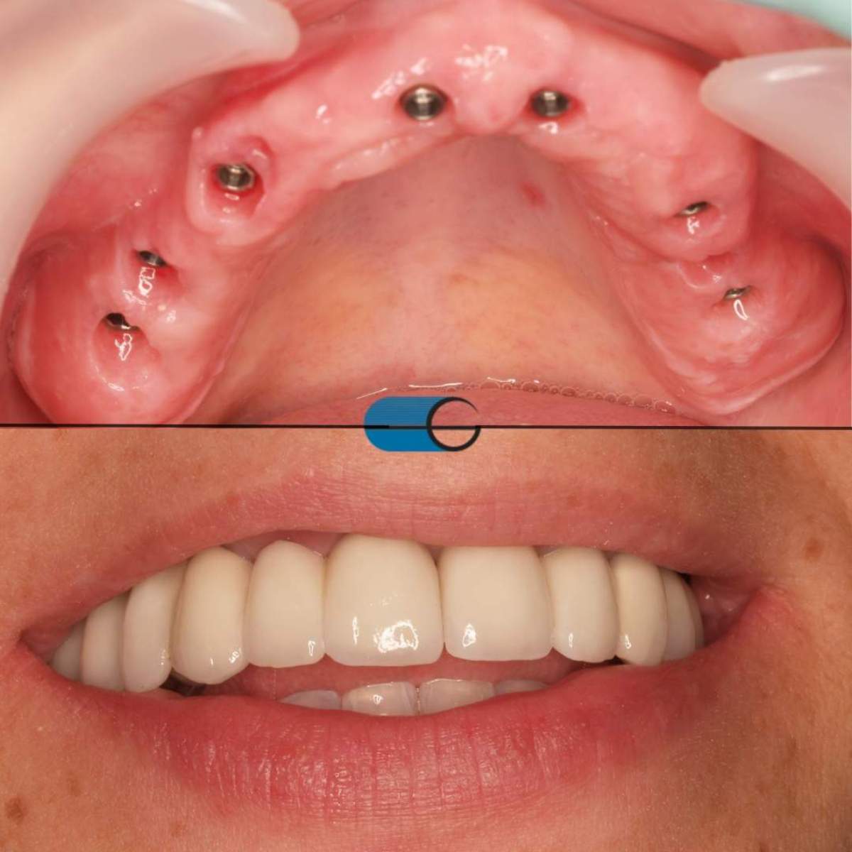 Implantes Dentários