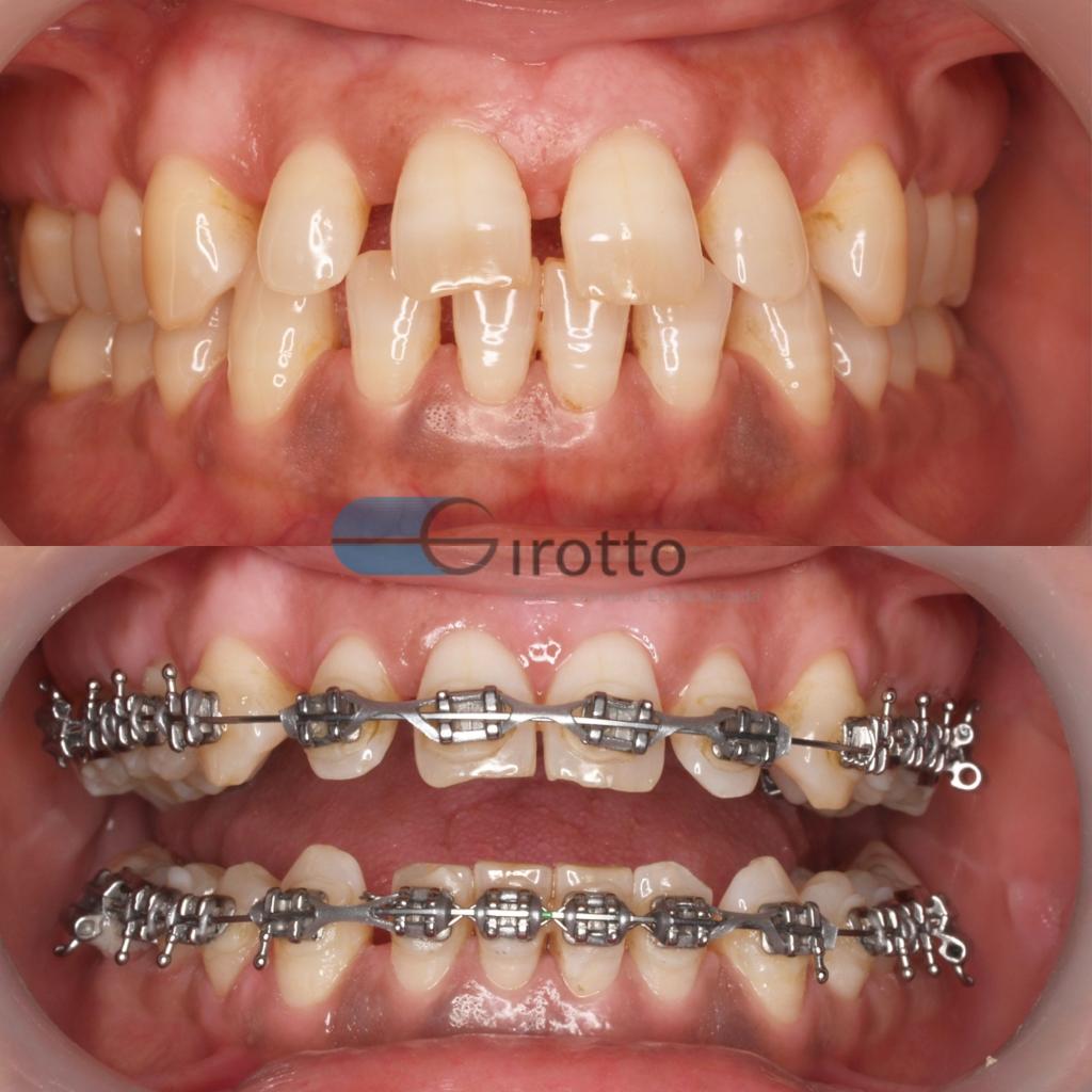 Ortodontia convencional