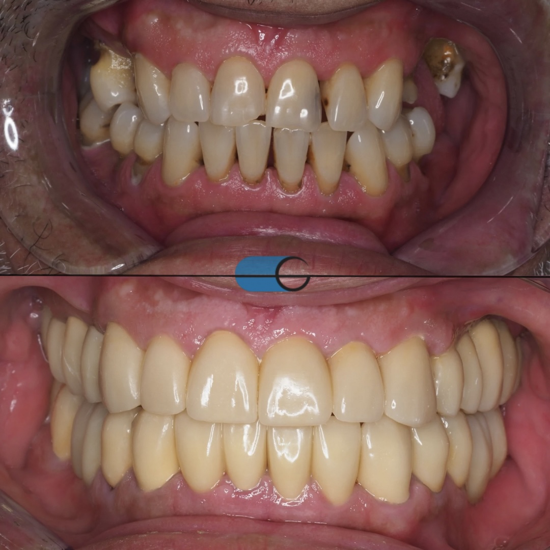 Prótese Fixa e Implantes