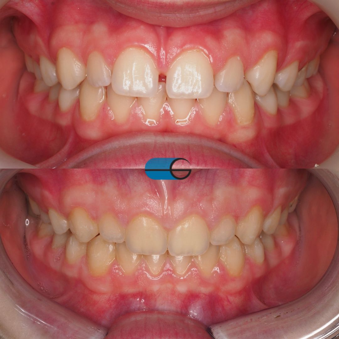 Alinhadores Invisíveis